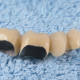 coroane-dentare-metalo-ceramice-1